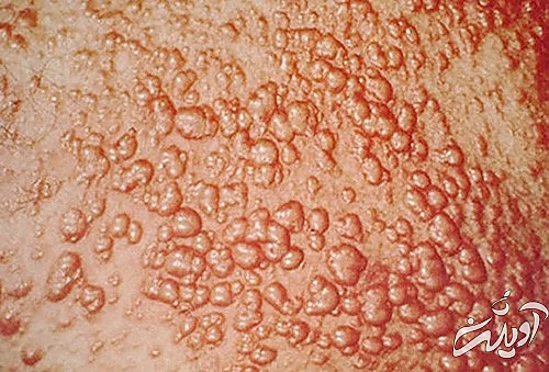 علائم سکته قلبی؛ ۱۲ نشانه ساده اما مرگبار